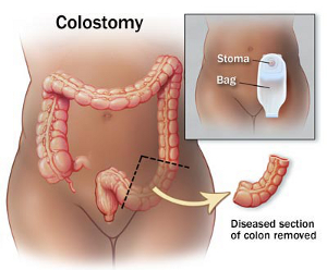 Illustration of a Colostomy