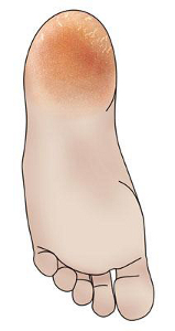 Illustration of a foot with cracked heels